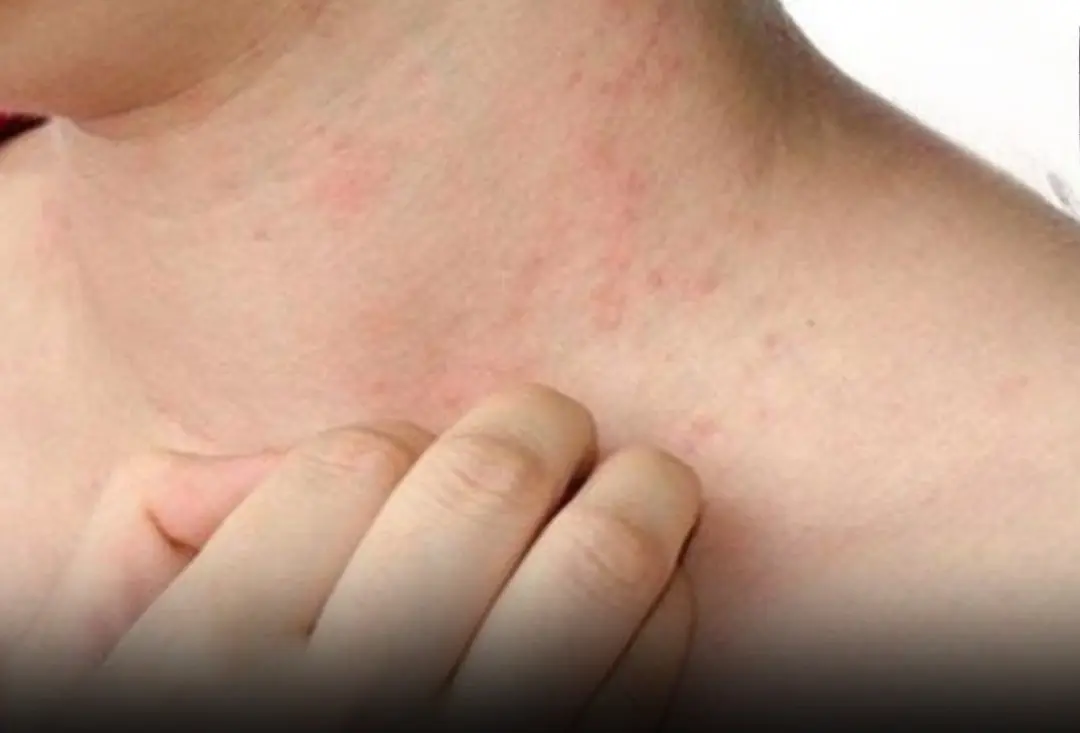 Persistent Itching in 2 Body Parts May Signal Liver Cancer, Not an Allergy