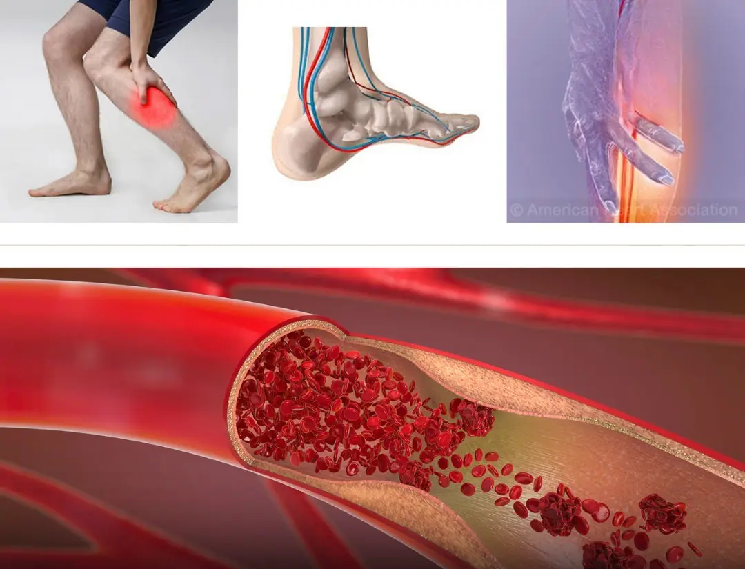 Heart Blockage Doesn’t Always Start in the Chest — These Nighttime Foot and Leg Signs Matter