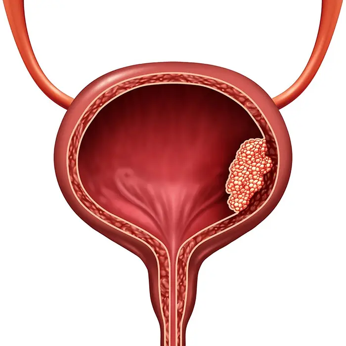Early Symptoms of Bladder Can:cer That Often Go Unnoticed