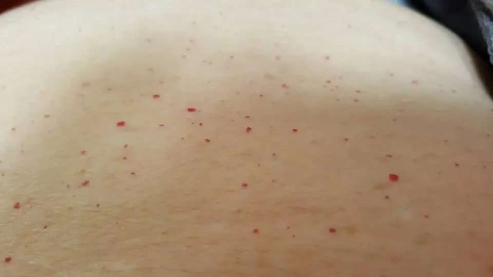 Noticing Red Dots Like These? Your Body Could Be Sending a Warning