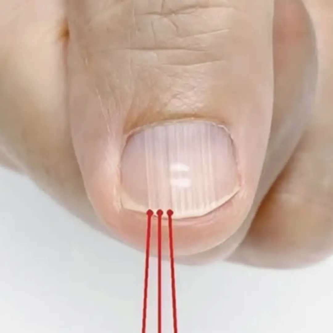 Lines like these on your nails may be a strong warning that...
