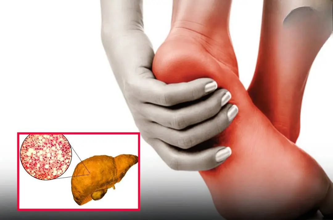 A change in your feet may signal severe fatty liver disease — don’t ignore it