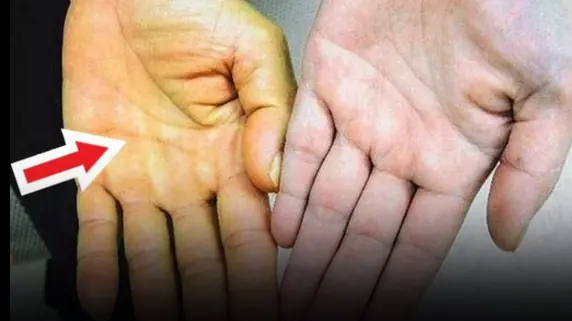 Before cancer arrives, hands and feet often have these 4 signs