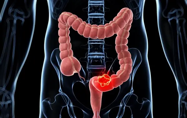 Before your colonoscopy - ask this one crucial question