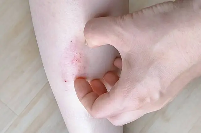 A 40-Year-Old Man Diagnosed With End-Stage Li.ver Can.cer: He Ignored a Warning Sign for Three Months