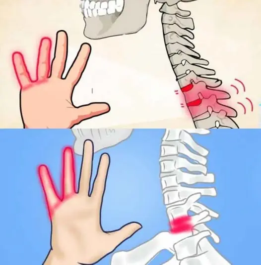 If your HANDS fall asleep it's a clear sign that you have can...