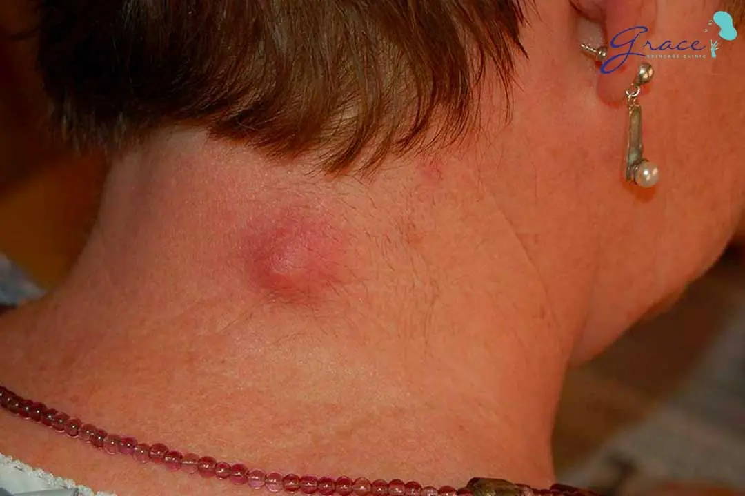 Neck Lumps: Causes, Symptoms, and When to Be Concerned