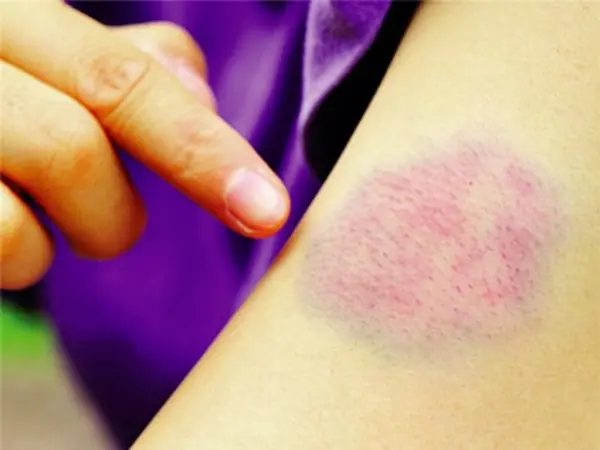 Unexplained Bruises: What Doctors Say They Could Indicate