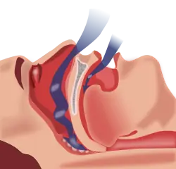 Snoring and 5 Unusual Signs of Obstructive Sleep Apnea