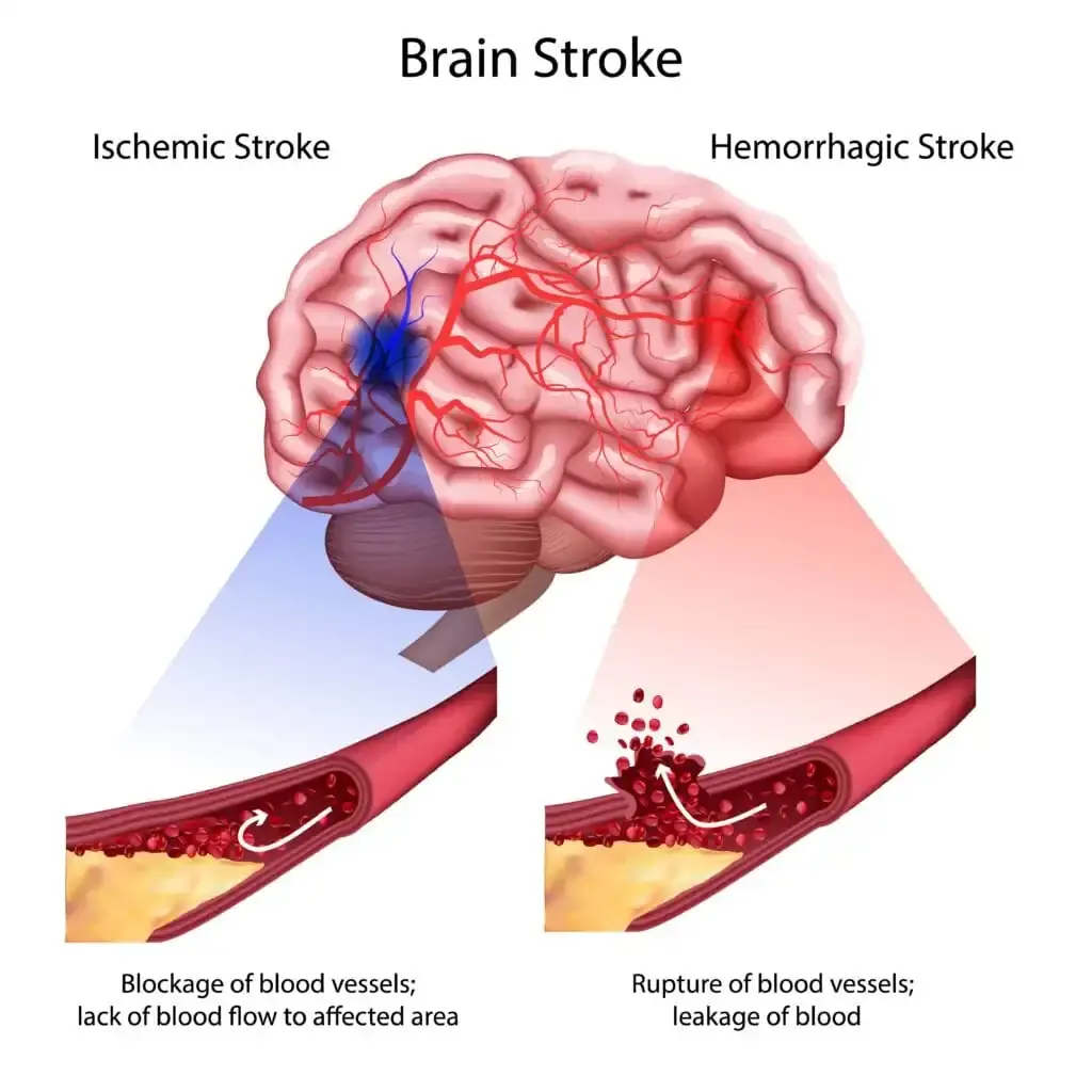 3 Stroke Symptoms That Require Immediate Attention