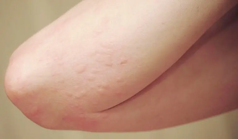He Ignored the Itching, Thinking It Was an Allergy — Until Doctors Found the Real Cause