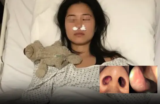 Woman Develops Fungal Growth Inside Her Nose Due to a Common Habit Most People Don’t Realize Is Dangerous