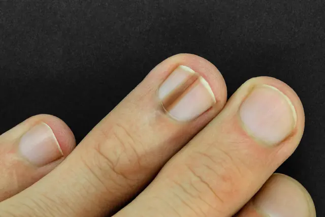 Vertical ridges on fingernails: A dang.erous warning? Don’t ignore these 4 signs