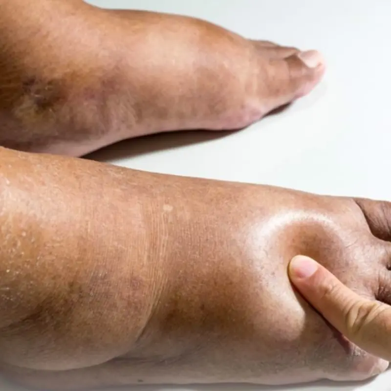 Your Feet as a Silent Warning System: 5 Unusual Signs of Diabetes