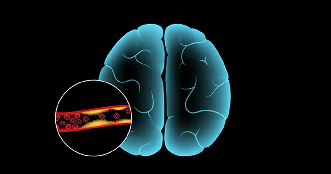 Doctor Warns About Signs of Transient Brain Ischemia: Don’t Ignore These Subtle Symptoms