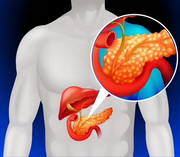 Be alert to 11 early signs of pancreatic canc.er that you should not ignore