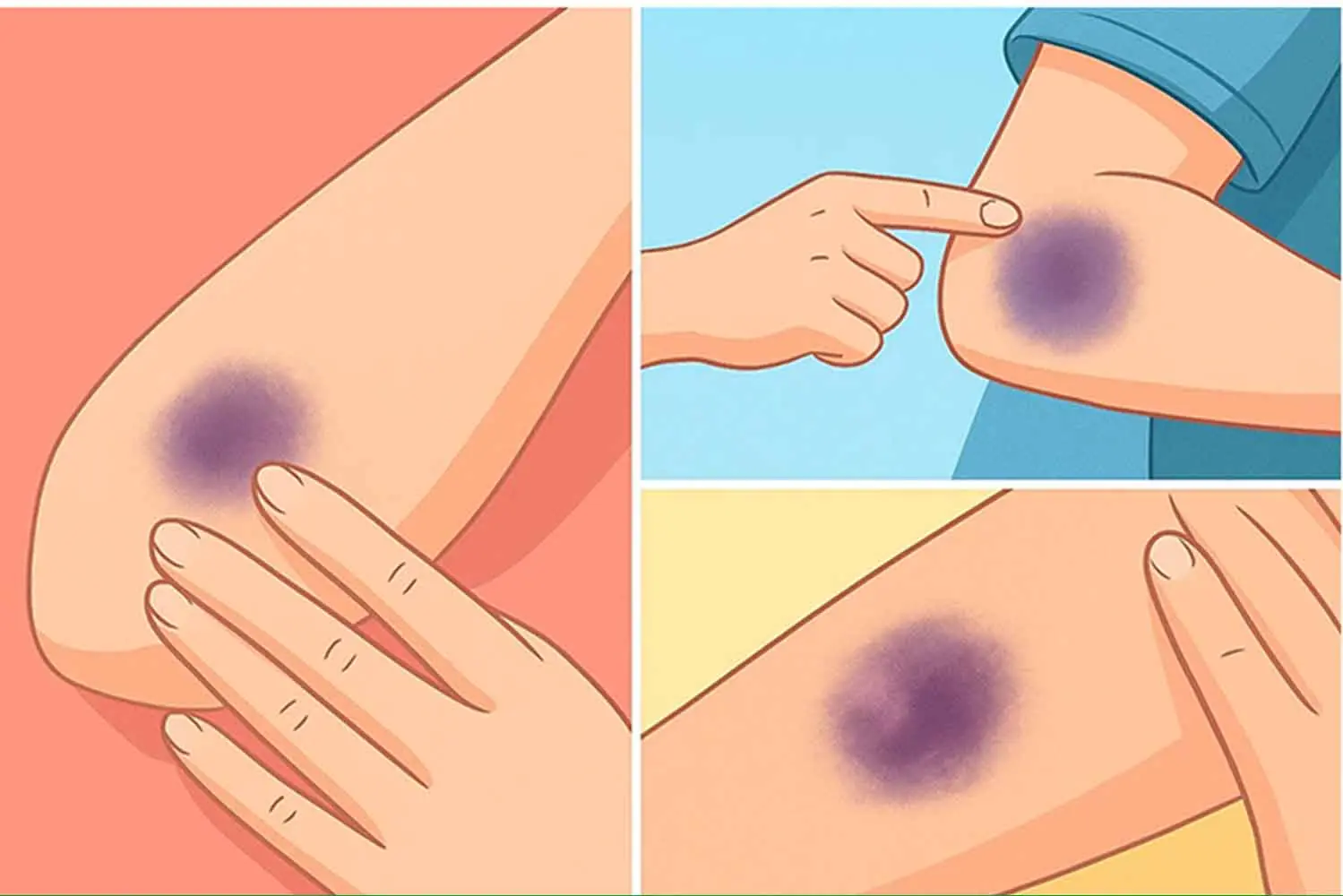 Be Careful If You Notice These Bruises on Your Body — Here’s What They Mean