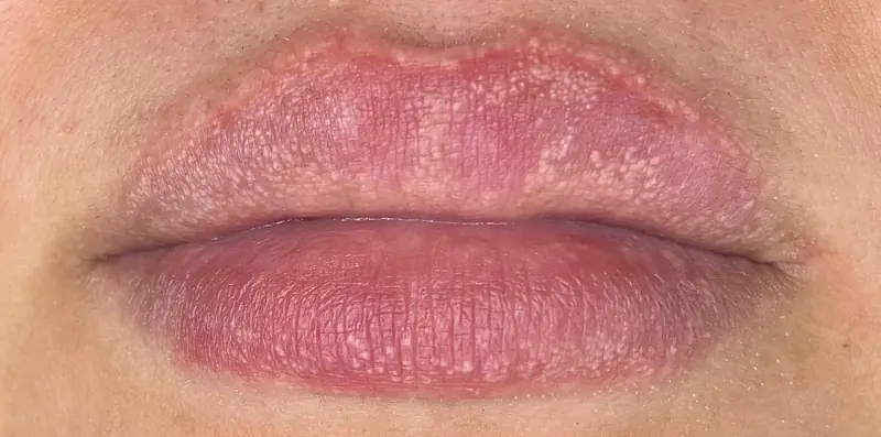 Warning: The Sho:cking Reason People Get Strange White Bumps on Their Lips or Private Parts