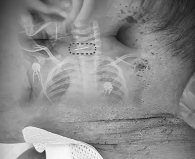 Boy suffers fever and convulsions; doctors discover something terrifying