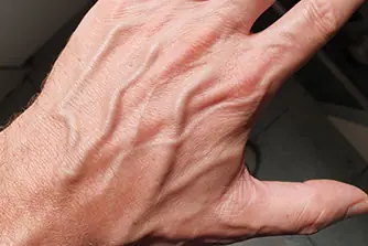If you see someone with bulging veins, you must tell them these things
