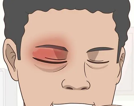 Blurred vision in one eye with headache: Warning signs you shouldn't ignore