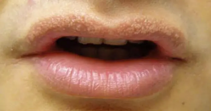 Reason people get strange white bumps on their lips or private parts