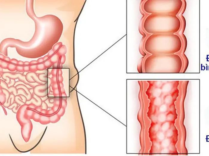 6 Subtle Signs of Stage 1 Colon Cancer You Should Never Ignore