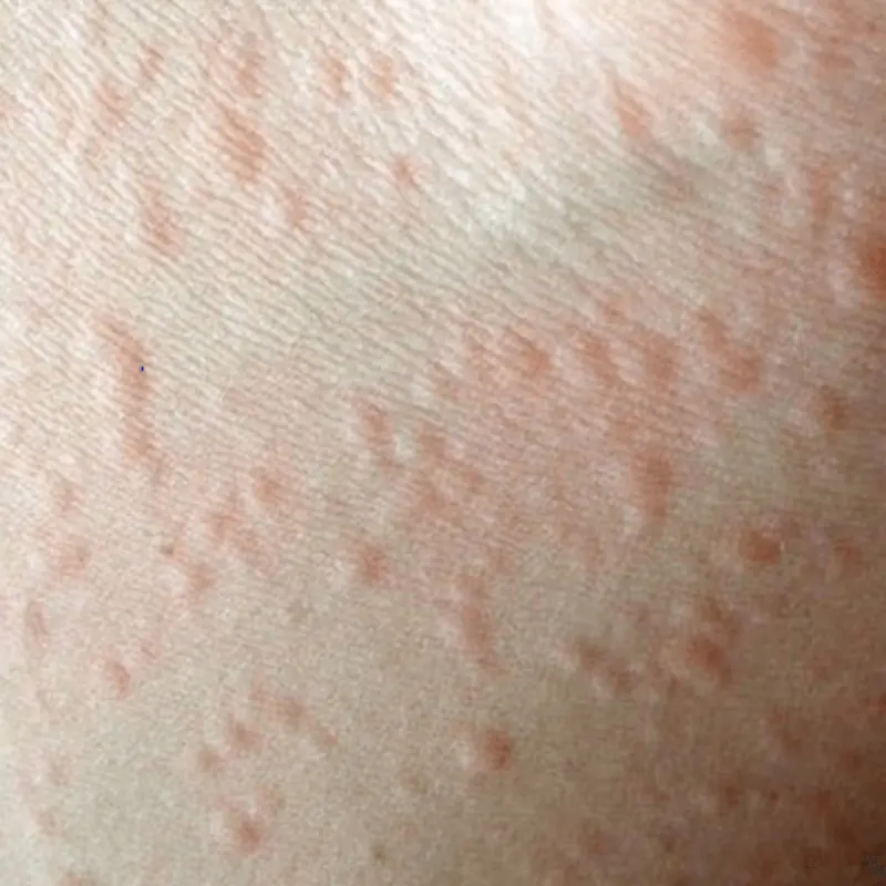 When Your Skin Speaks: What Persistent Itching and Bumps May Reveal