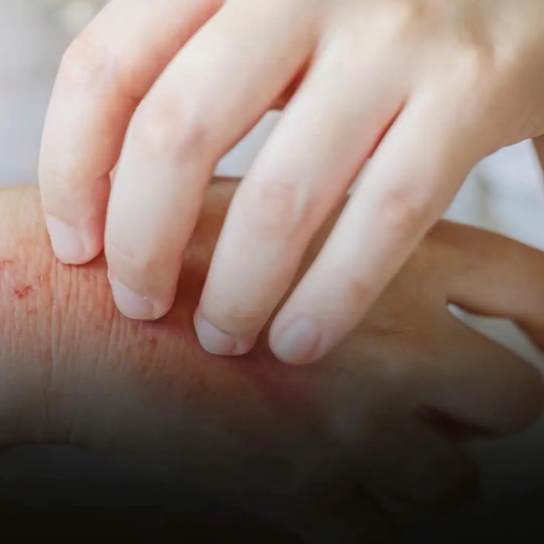 Surprising causes of hives revealed - What may be triggering your skin