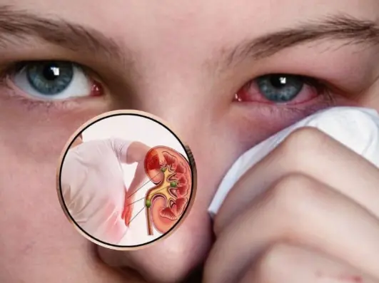 8 signs of kidney failure that if ignored may require lifelong dialysis