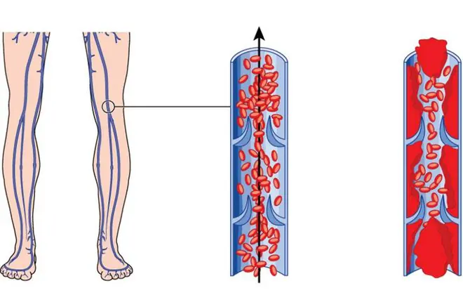 Struggling with Poor Circulation, Cold Feet, or Varicose Veins? These 6 Changes Can Help