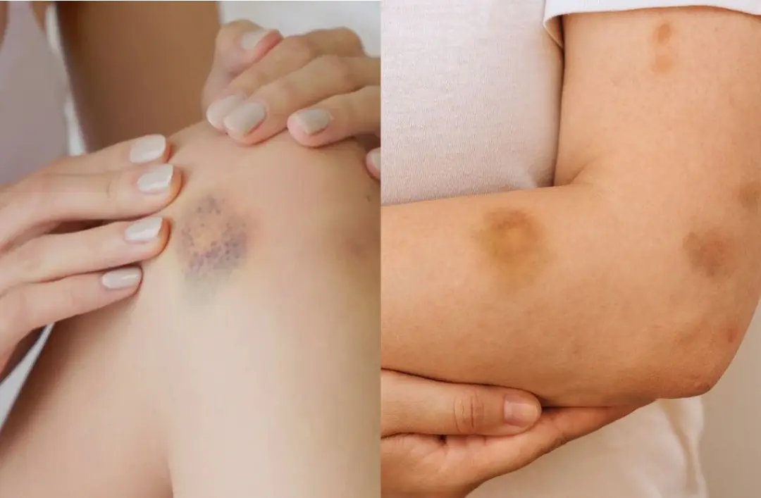 BE CAREFUL, if you get these bruises on your body, here’s what it means....