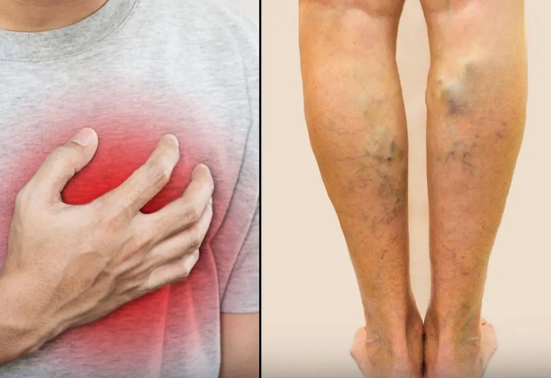 Heart Attacks Rarely Happen Suddenly — 5 Warning Signs That May Appear Up to 3 Months Earlier