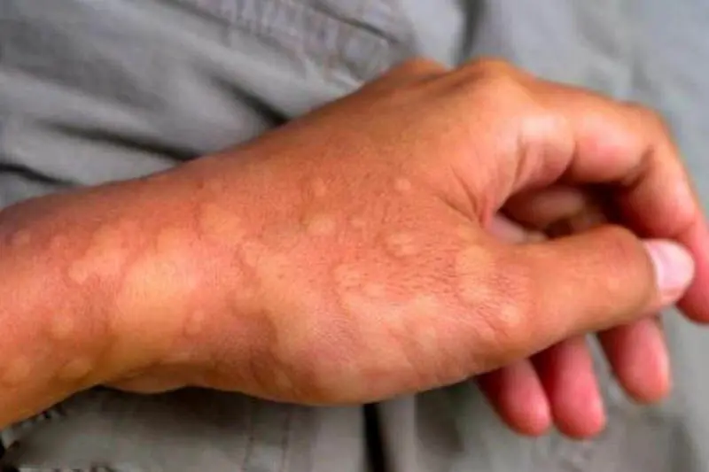 Persistent Itching Leads to Shocking Diagnosis: 37-Year-Old Woman Found Infected With Five Types of Parasites