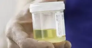 Men and women who see these 3 signs in their urine need to see a doctor for kidney failure immediately