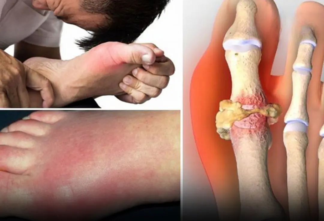 Gout is becoming increasingly common, and if you have it, certain foods should be strictly avoided to prevent painful flare-ups