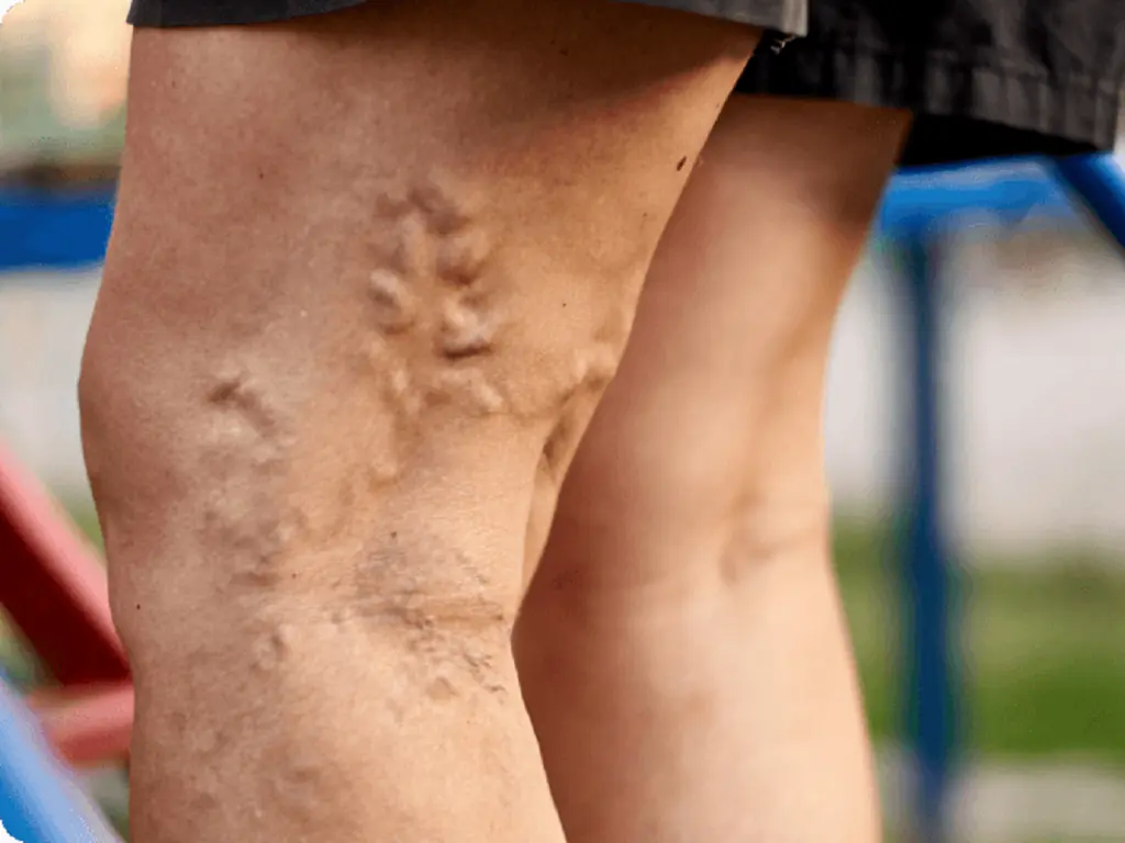 Are feet an "early warning sign" of cer.vical can.cer? Don't ignore these 4 situations