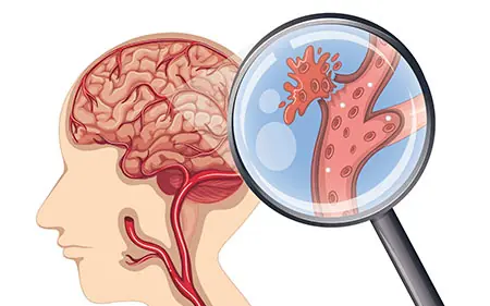 Don’t Dismiss These Signs — They Could Signal a Dea:dly Aneurysm