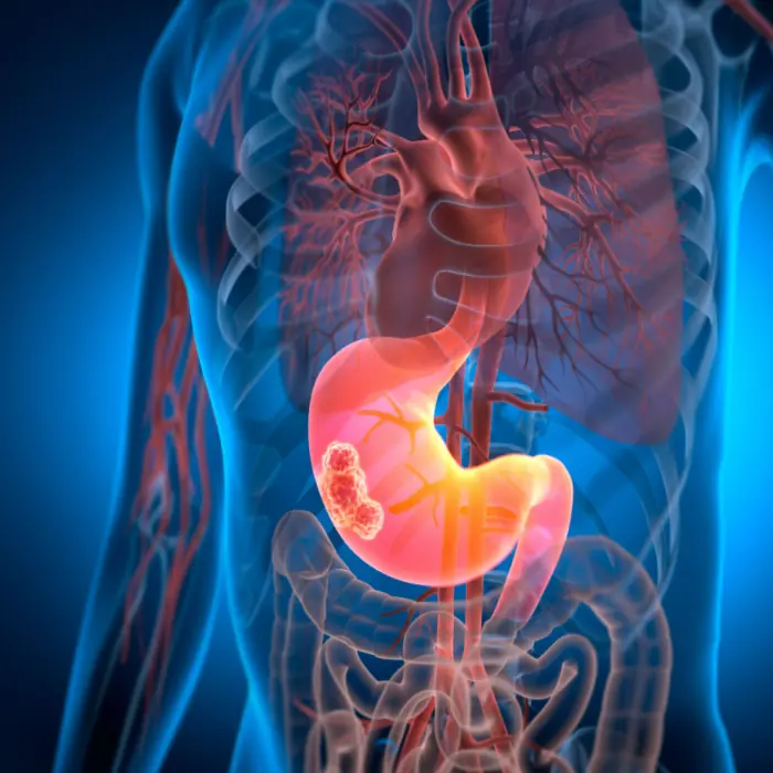 Pancreatic Can.cer: Two Symptoms That Came Too Late
