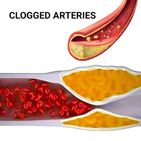 10 Warning Signs You May Be Living With Clog.ged Arteries — And Not Know It