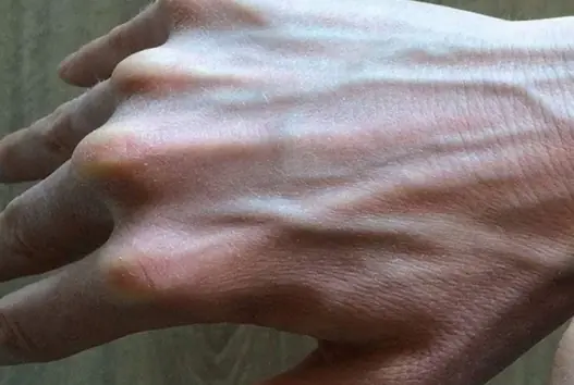Why Are My Veins Suddenly Bulging and Visible?