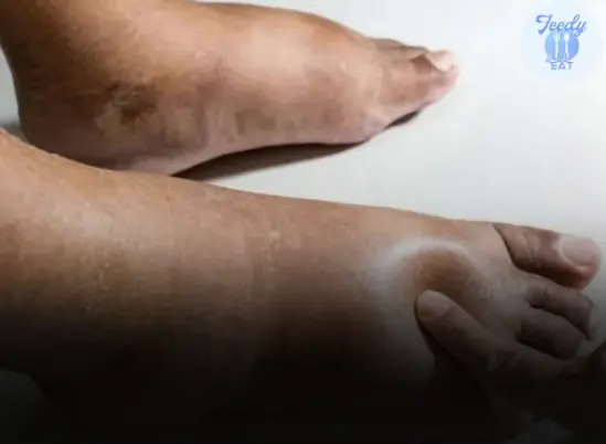 6 Simple Ways to Reduce Water Retention