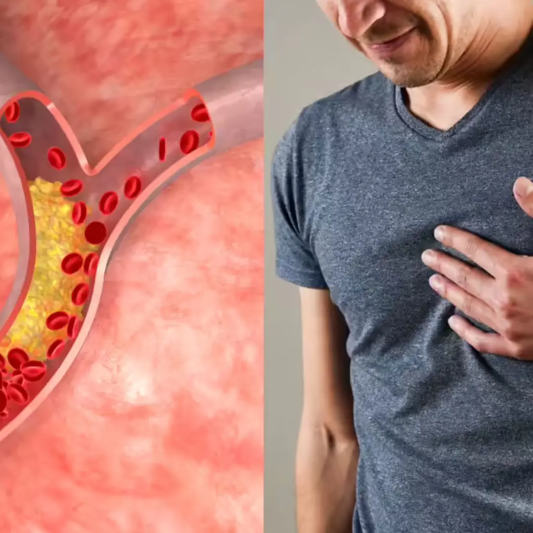 Are Your Arteries Blocked? Symptoms You Shouldn’t Ignore