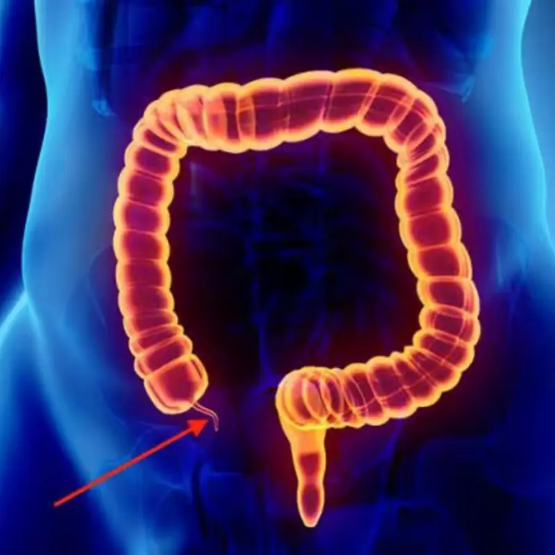 5 Warning Signs of Appendicitis You Should Never Ignore