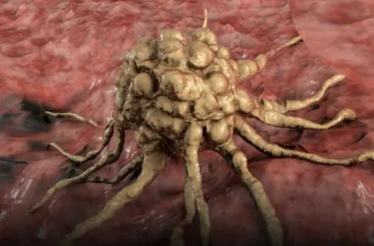 Signs Your Immune System Is Responding to Cancer Early On