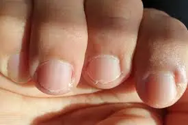 Weak or Brittle Nails: What Your Body Is Trying to Tell You