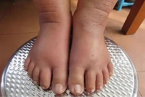 Pancreatic Can:cer: 4 Leg Symptoms You Might Be Overlooking