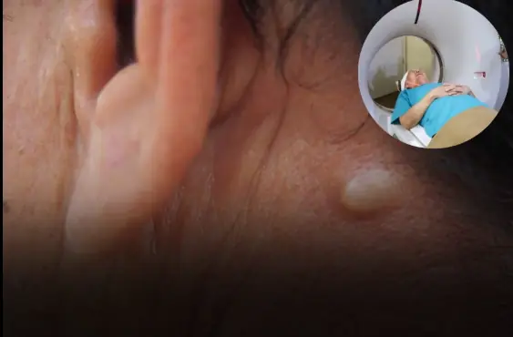 5 Subtle Signs of Thyroid Cancer You Can Spot Early