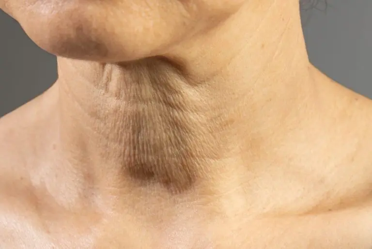 If the Skin on Your Neck Is Starting to Loosen, Here’s Why It Happens