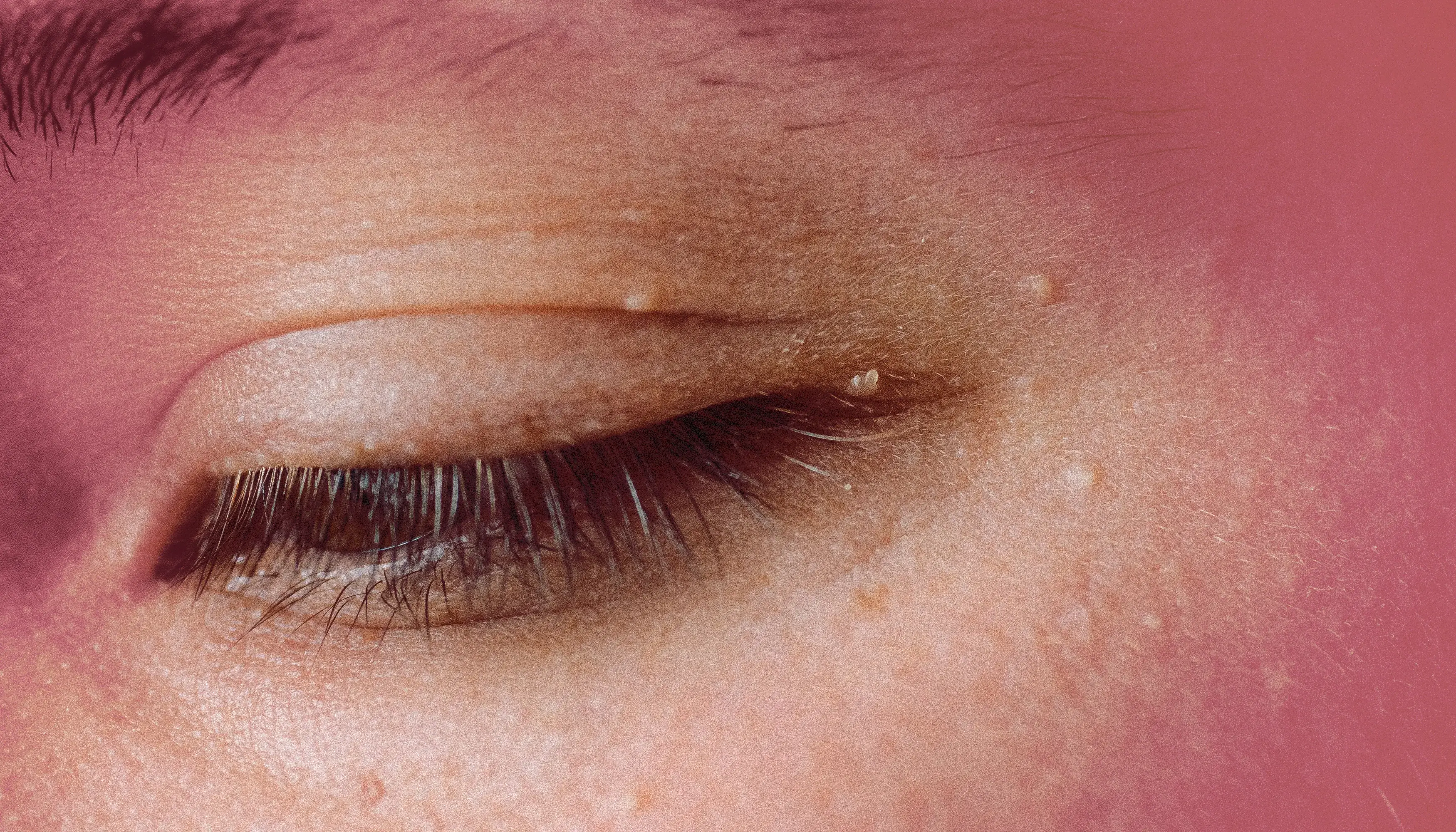 From Styes to Cysts: 6 Eyelid Bumps and How to Treat Each One